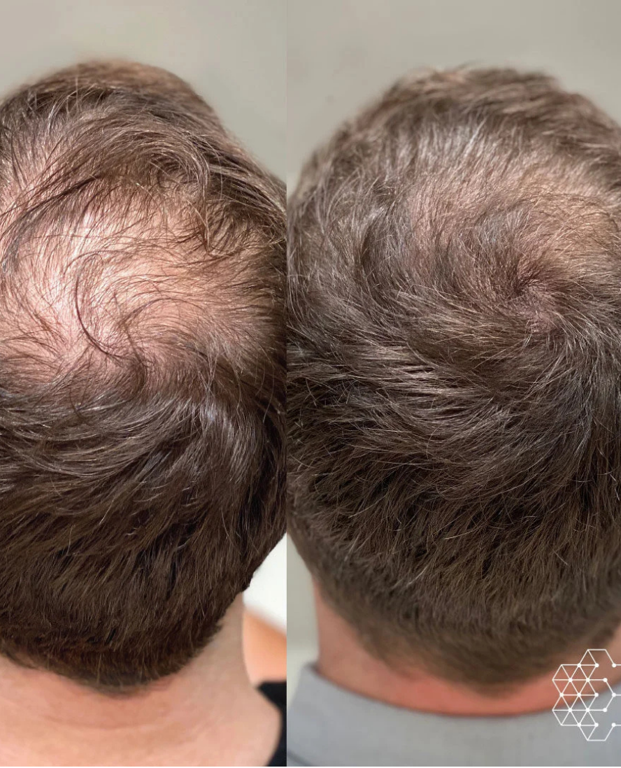 PRP Treatment